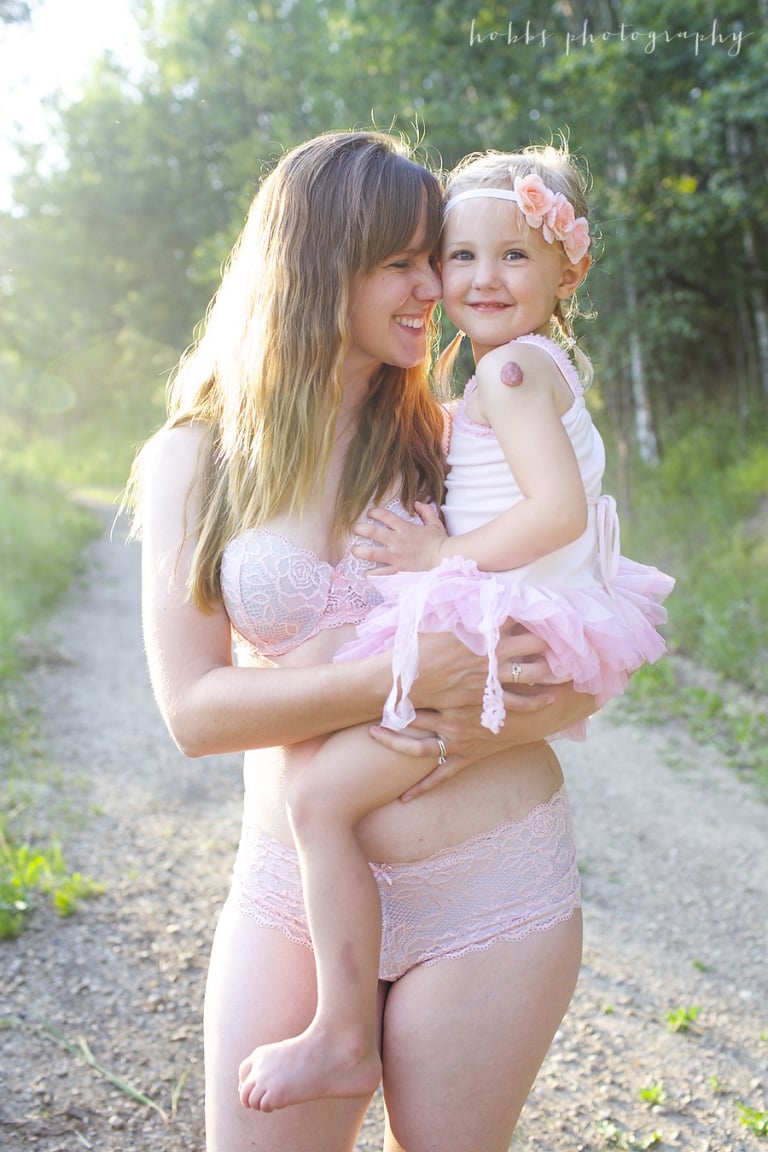 mother learns about self love from daughter with haemangioma