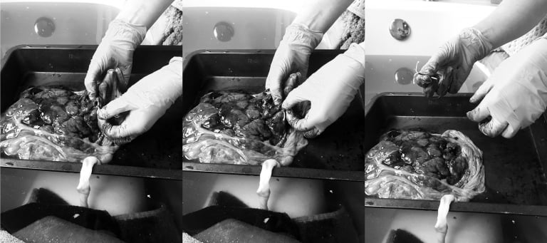 midwife removes IUD embedded in placenta at Edmonton homebirth