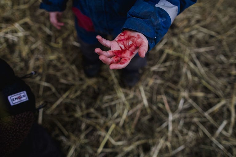 child's hand covered in blood