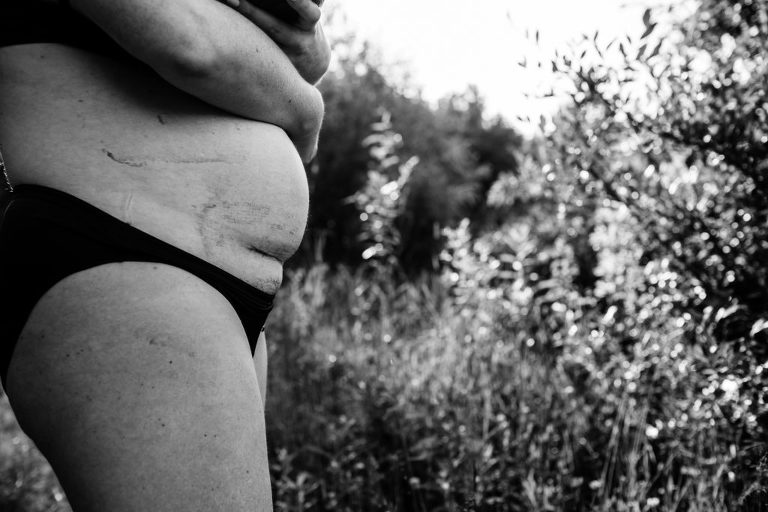 postpartum photography black and white details photo of a cesarean scar one week postpartum